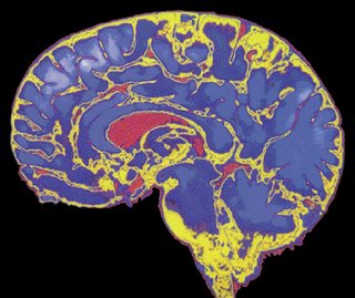 El alzheimer es una enfermedad degenerativa que afecta al cerebro