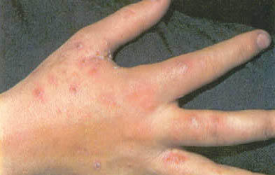 Do Scabies Look Like Bites Do Scabies Look Like Bites