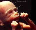 Abortion, Pro-life