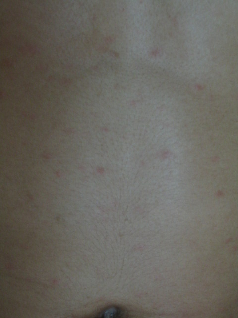 Rote punkte auf der brust