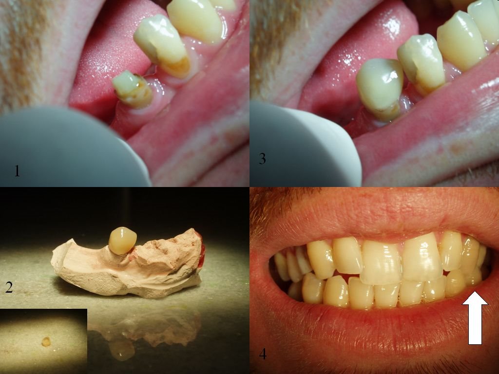 Dr Marlo Vinicios Duarte Lemos - Cirurgião Dentista - Odontologia: Prótese  - Coroa de jaqueta Acrílica
