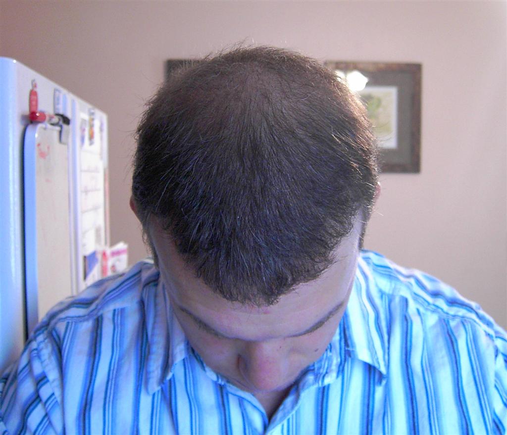 Long Haircuts Front And Back View Hair Transplant 2 - Month 6.5 - Haircut