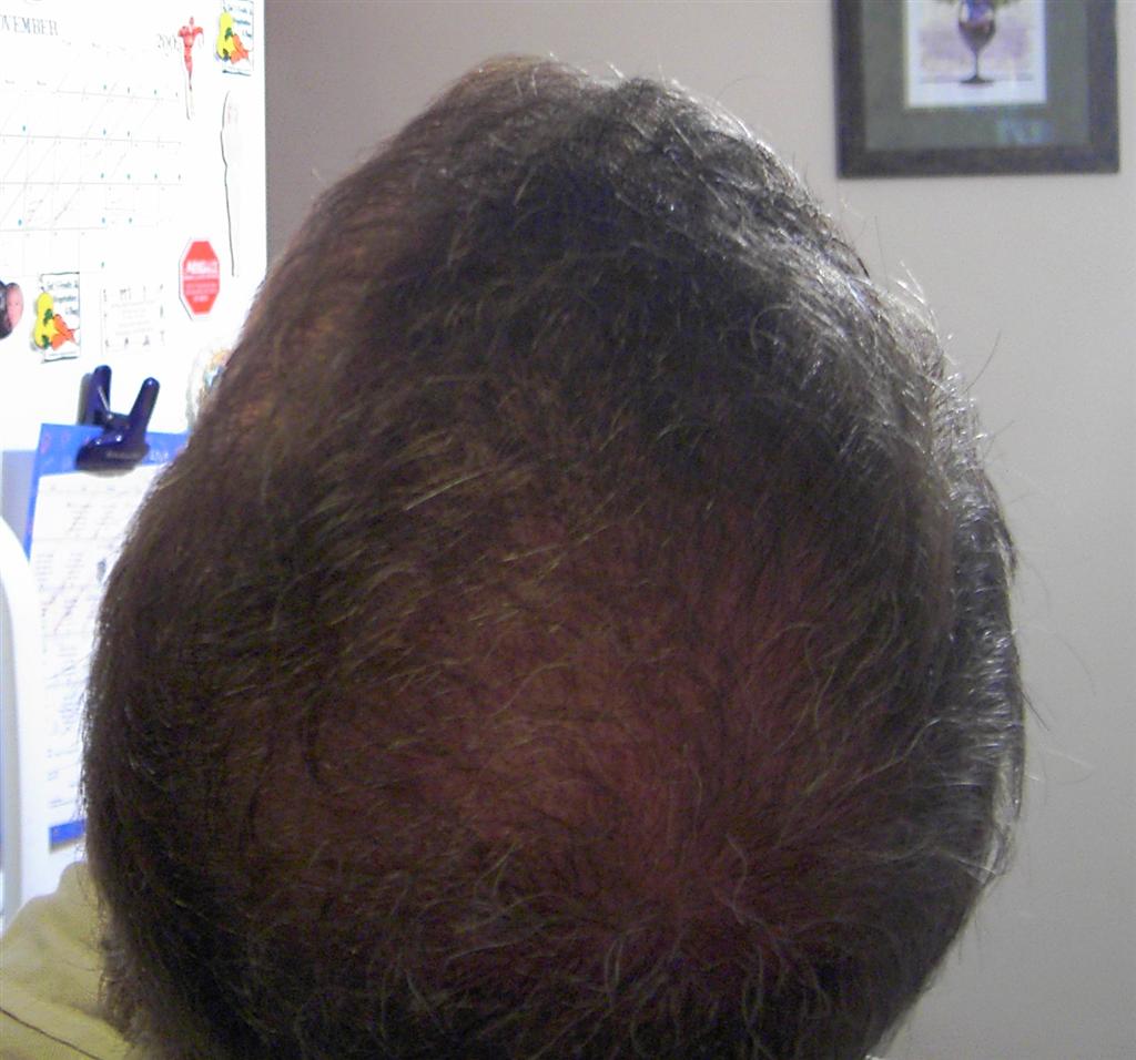 Long Haircuts Front And Back View Hair Transplant 2 - Month 5