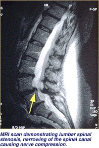 MRI Scan of Lumbra Spinal Stenosis