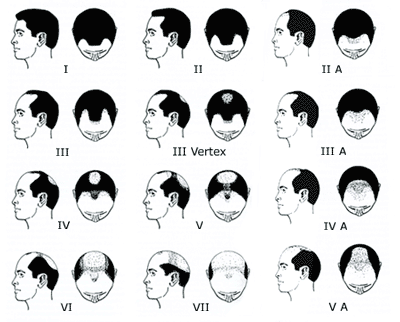 Hamilton's Male Pattern Hair Loss Chart