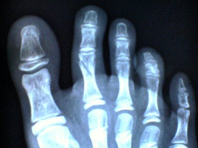X-ray Son's Right Foot 2nd Toe Fracture