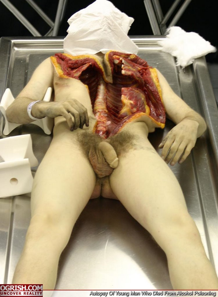This set shows the autopsy pictures of a young male from Boston, USA, who d...