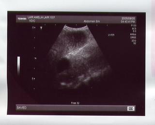 amelia's liver ultrasound