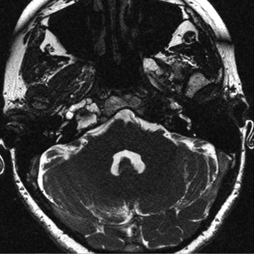 Intestin apres radiotherapie carcinoma sigmoid