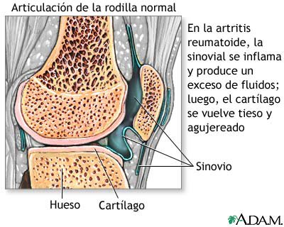 Ha tirado la espalda duele la espalda en los riñones