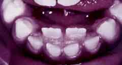 children teeth growing behind other teeth