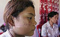 Bearing the scars - Noviana Malewa in Tentena, Sulawesi, yesterday