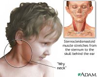 What is adult torticollis?