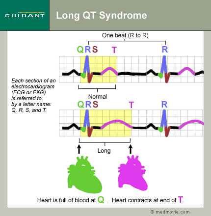 long qt syndrome essay long qt syndrome essay