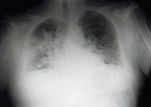 Radiografía de pulmón de un enfermo de cáncer.