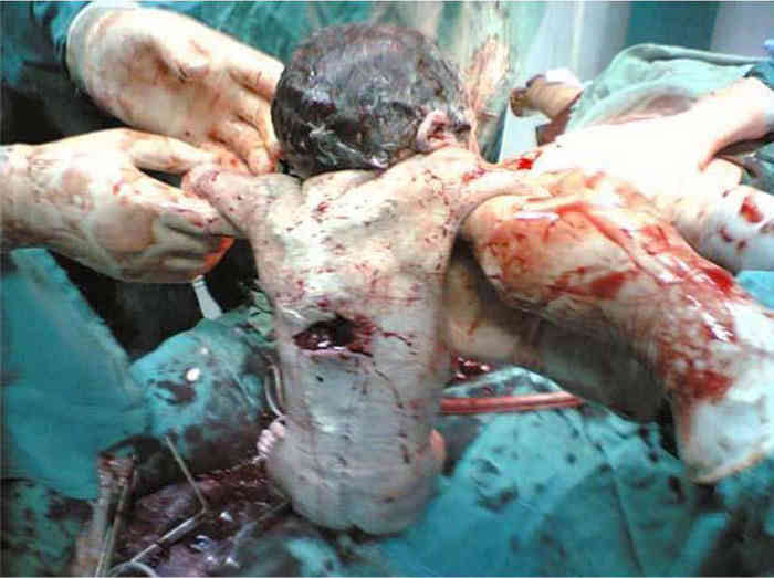 Child shrapnel mother's womb