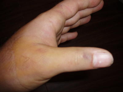 5 days after breaking my thumb