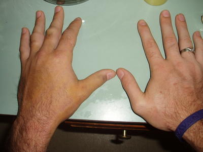 Check out these two hands, can you see a difference?  No thumb nuckle on the left hand =/