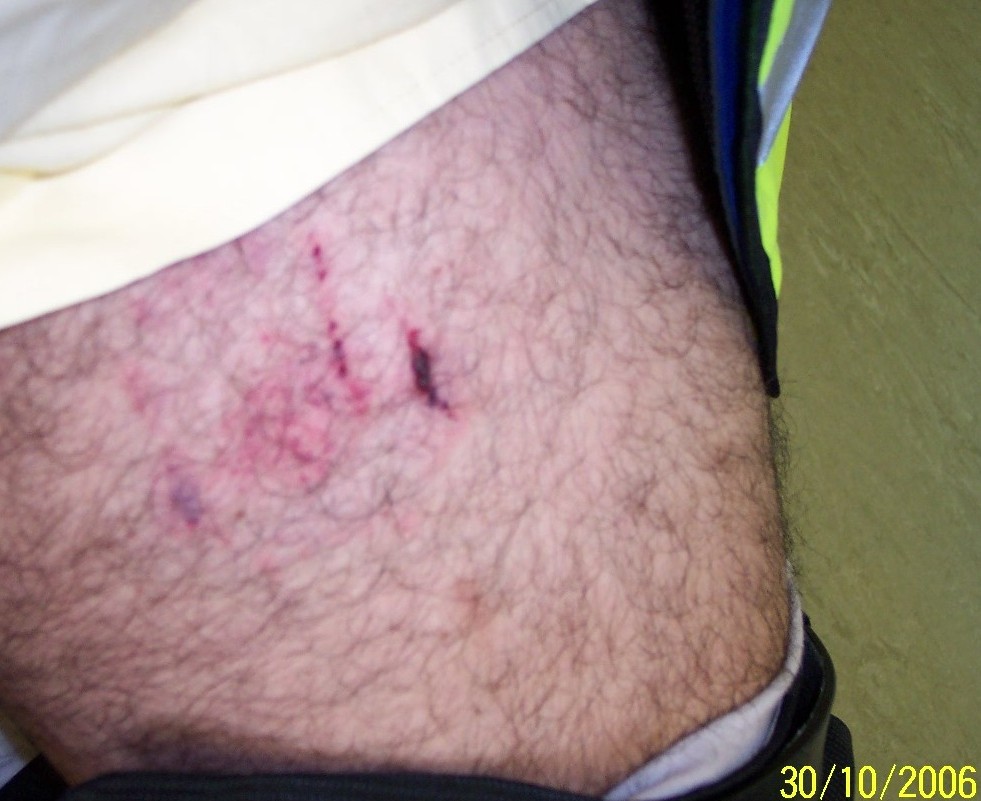 biting leg bites on leg www imgarcade image arcade biting leg bites on leg www imgarcade image arcade