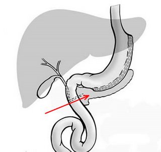 Sleeve gastrectomy(Gastric Sleeve Operation) after operation