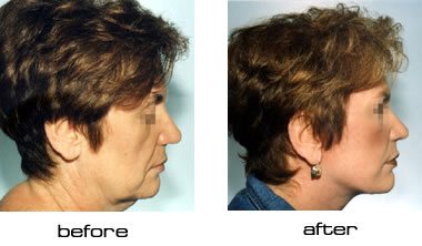 Face lift before after pictures (photos)