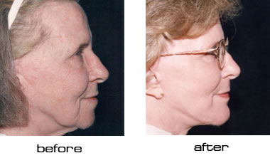 Face lift before after pictures (photos)
