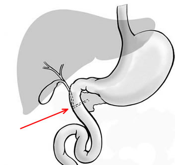 Sleeve gastrectomy(Gastric Sleeve Operation)