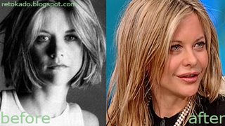 Meg Ryan's Before and After Lip Surgery Picture