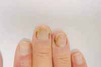 Yeast Infection of the Nails