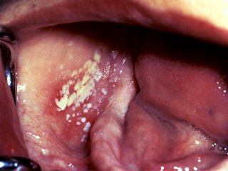 Yeast Infection Oral Thrush