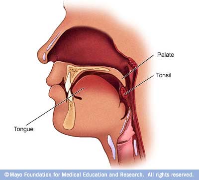 one sided tonsillitis