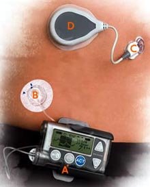 MiniMed Paradigm® REAL-Time Insulin Pump and Continuous Glucose Monitoring System