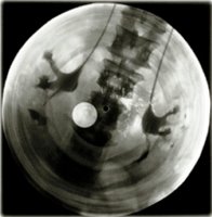 X-Ray plates as replacement for records.