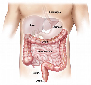 pictures of colon cancer