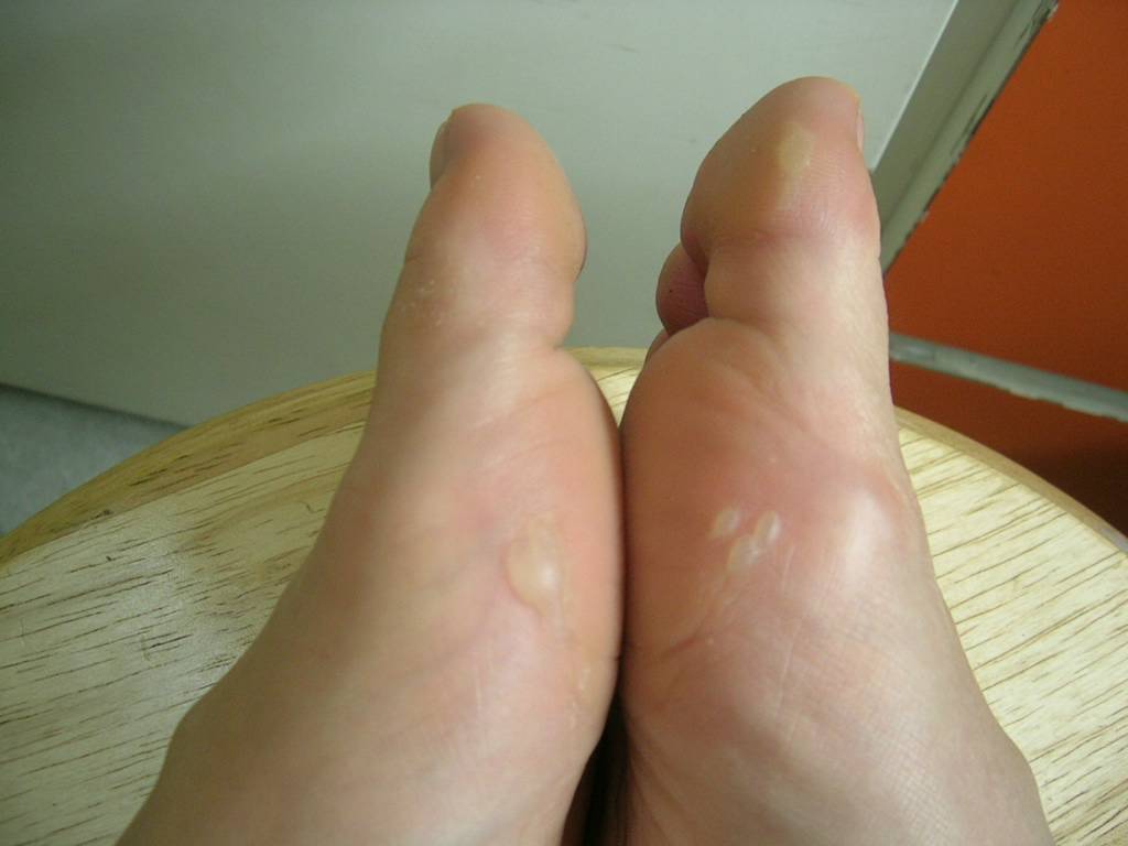 Cause and Effect: Ugly ballerina's feet