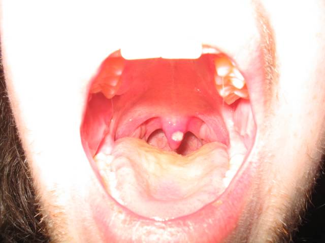 White Patch In Throat Not Strep
