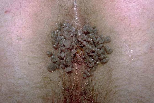 This is a picture of anal warts. 