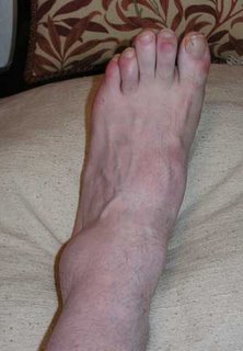 My swollen ankle