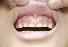 Children with brownish horizontal line on gum