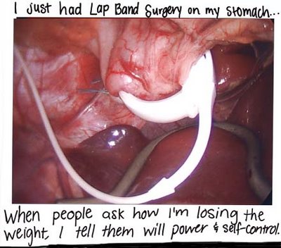 lap band surgery