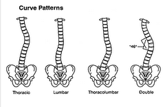 Scoliosis Curve Patterns