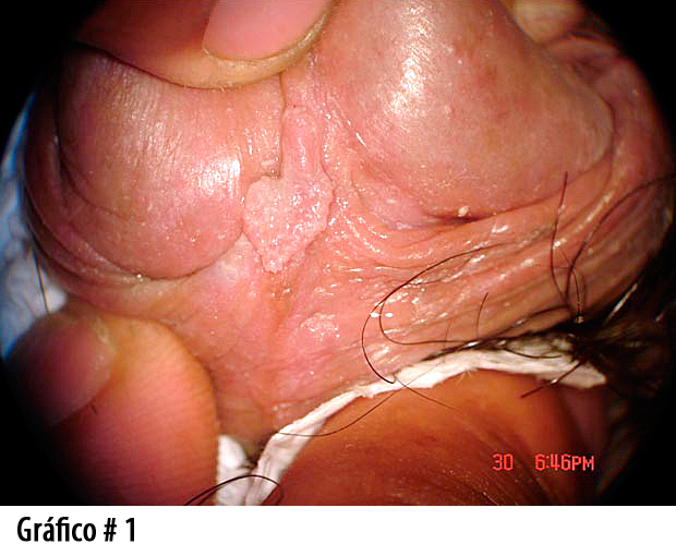 Foto1. lesión condilomatosa en pene