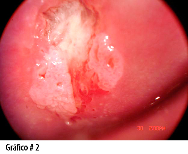 Foto2. Lesion HPV subclinico en cervix
