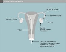 La inseminacion artificial