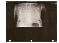 Chest X-ray Before Surgery