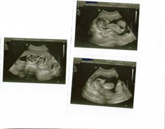Scans of twins. 14 & 15 weeks..look how close!