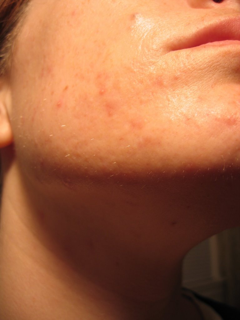 Tazorac before and after pictures — photo 1