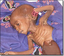 Severely malnourished girl in a Doctors Without Borders feeding clinic in Western Darfur