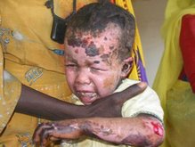 This child is a victim of a helicopter bombing run in Darfur, carried out by the Sudanese govt.