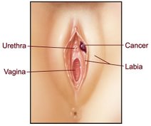 Kanker Vulva